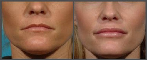 Lip Enhancement