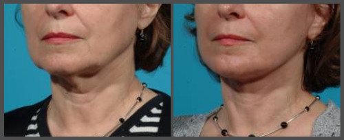 Lower Face and Neck Lift with Fraxel Re:Pair