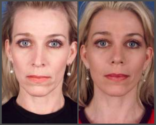 Dr. Hobar - Rhinoplasty and Facelift