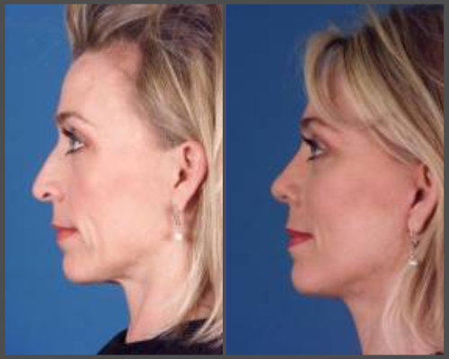 Dr. Hobar - Rhinoplasty and Facelift