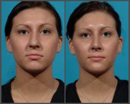 Dr. Hobar - Rhinoplasty