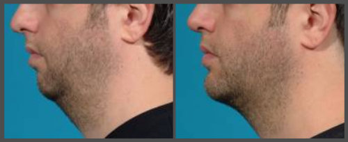 Dr. Hobar - Rhinoplasty and Chin Surgery