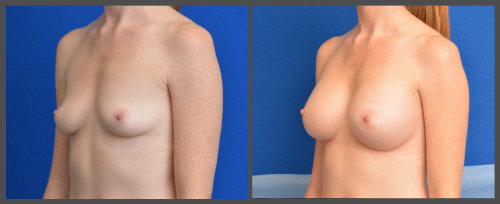 Breast Augmentation - Dr. Hobar