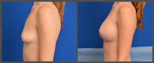 Breast Augmentation - Dr. Hobar