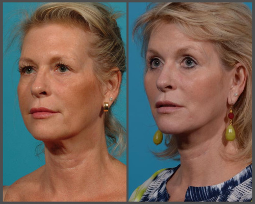 Natural Facelift - Dr. Hobar