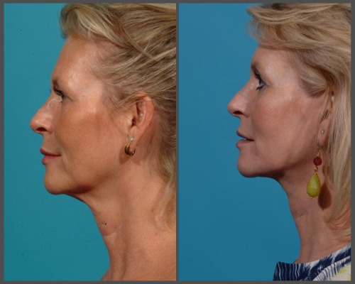 Natural Facelift - Dr. Hobar