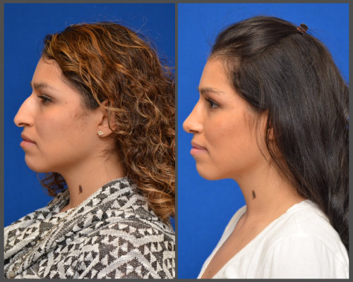 Rhinoplasty