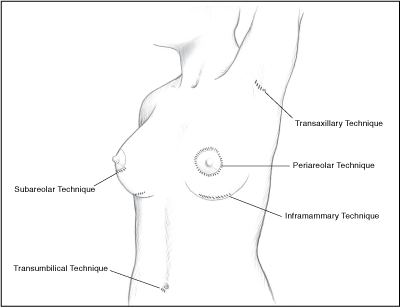 Breastfeeding with Implants