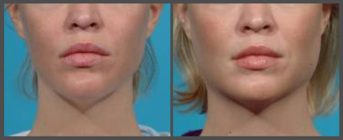 The Female Custom Jawline Implant Design - Explore Plastic Surgery