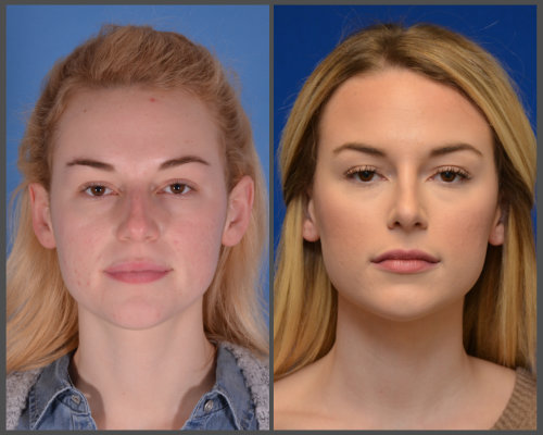 rhinoplasty