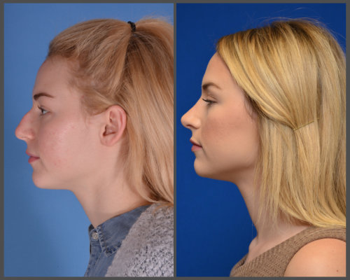 rhinoplasty