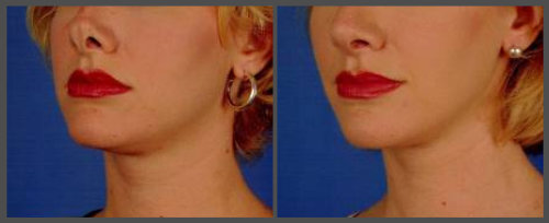 Dr. Hobar - Rhinoplasty