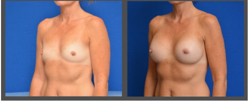 Breast Augmentation - Dr. Hobar