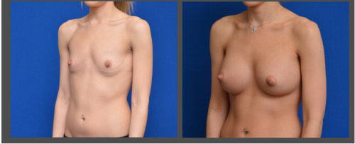 Breast Augmentation - Dr. Hobar