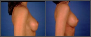 Breast Augmentation