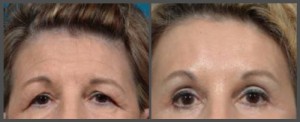 Browlift and Eyelid Surgery