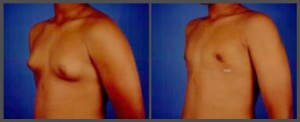 Gynecomastia