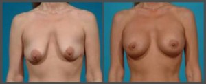 Breast Enhancement Dallas TX