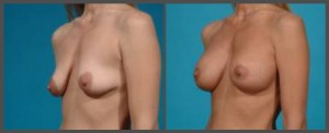 Breast Implant Exchange Dallas TX