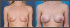 Breast Enhancement Dallas TX