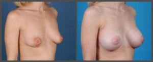 Breast Augmentation Dallas TX