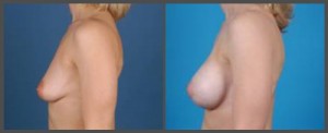 Breast Enhancement Dallas TX