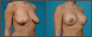 Breast Augmentation and Lift - Dr. Hobar