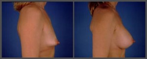 Tuberous Breast Correction
