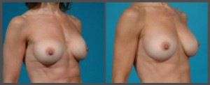 Breast Implant Exchange Dallas TX