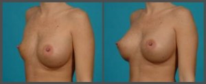 Breast Implant Deflation Dallas TX