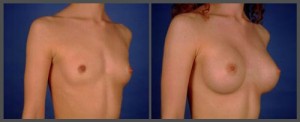 Breast Augmentation - Dr. Hobar