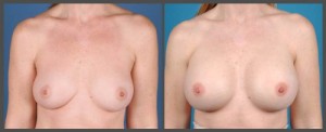 Breast Augmentation - Dr. Hobar