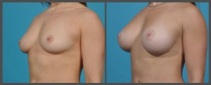 Breast Enhancement Dallas TX