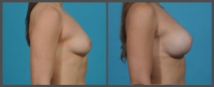 Breast Enhancement Dallas TX