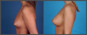 Breast Augmentation - Dr. Hobar