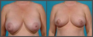 Breast Reduction