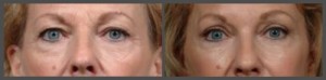 Eyelid Surgery