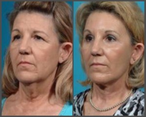 Facelift, Browlift, Eyelid Surgery