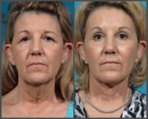 Facelift, Browlift, Eyelid Surgery