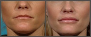 Lip Enhancement
