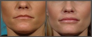 Lip Enhancement