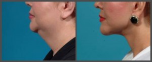 Lower Face and Neck Lift