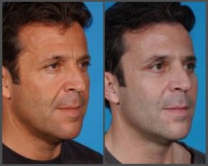 Midface Lift with Blepharoplasty