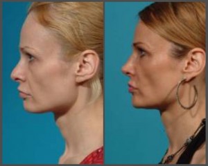 Rhinoplasty in Dallas TX