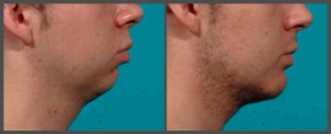 Dr. Hobar - Genioplasty