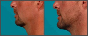 Dr. Hobar - Genioplasty