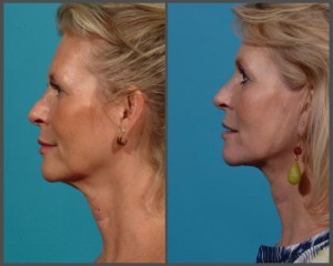 Natural Facelift